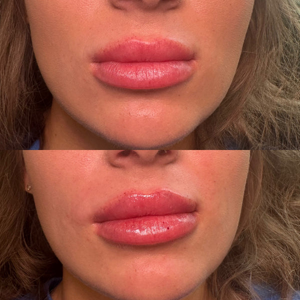 Lip Filler 1 syringe