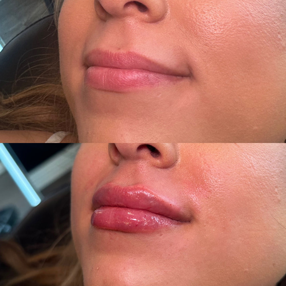 Lip Filler 1 syringe