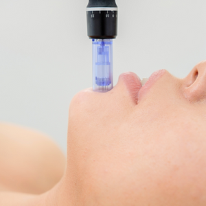 Combination of 3 Microneedling and 3 Chemical Peels