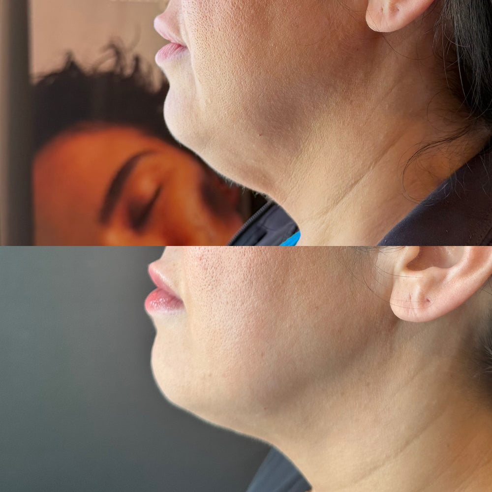 Chin fat dissolver (PCDC)