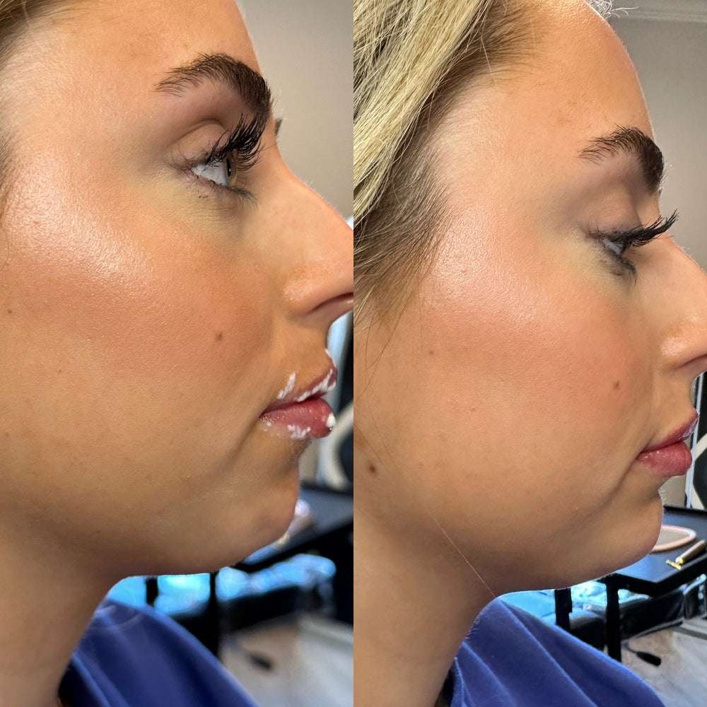 Chin Filler 1 syringe