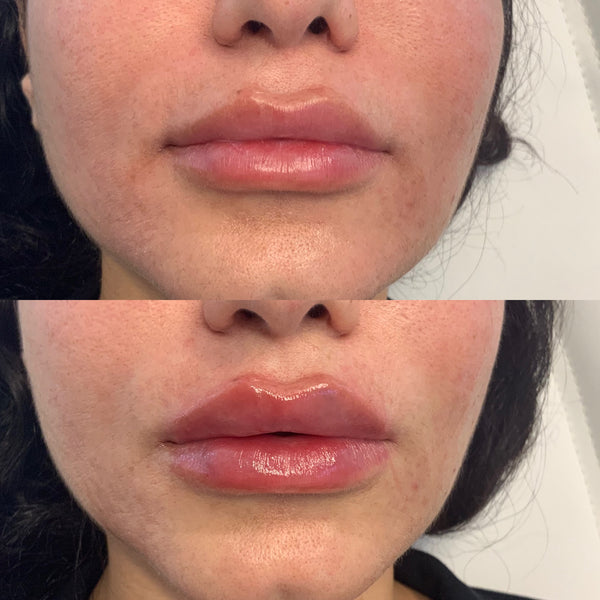 Lip Filler 1 syringe
