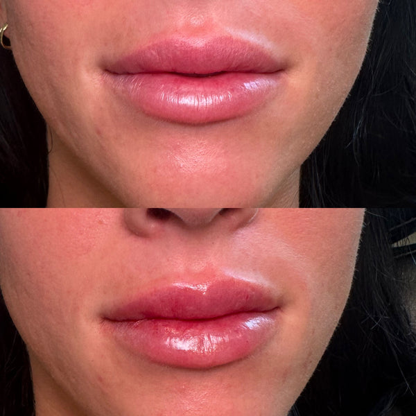 Lip Filler 1 syringe