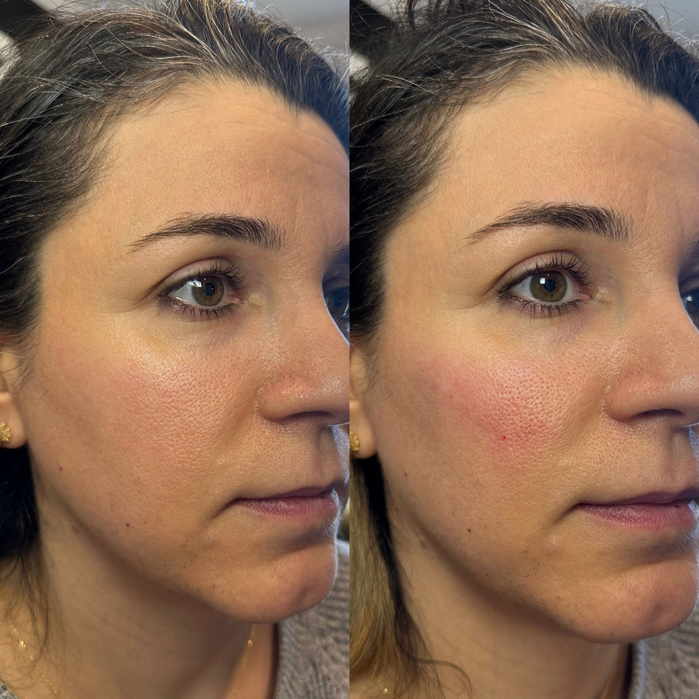 Cheek Filler 1 syringe