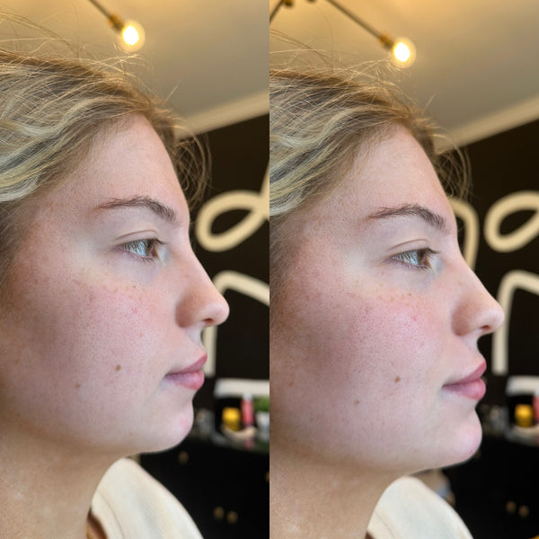 Chin Filler 1 syringe