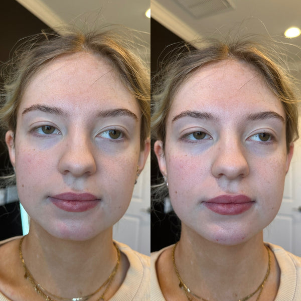 Chin Filler 1 syringe